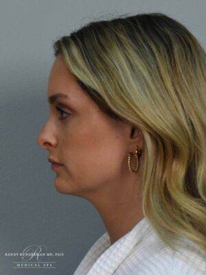 Dermal filler treatment patient photo, side profile view of the face — Dr. Rudderman, Atlanta.