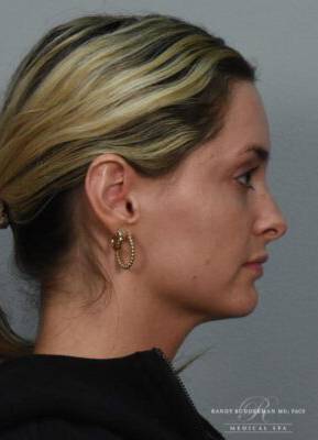 Dermal filler treatment patient photo, side profile view of the face — Dr. Rudderman, Atlanta.