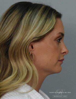 Dermal filler treatment patient photo, side profile view of the face — Dr. Rudderman, Atlanta.