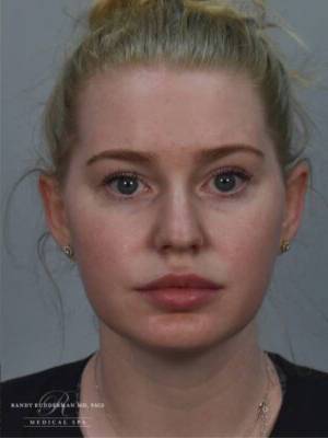 Dermal filler treatment patient photo, front view of the face — Dr. Rudderman, Atlanta.
