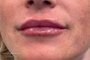 Face after dermal filler treatment, front view — Dr. Rudderman, Atlanta.