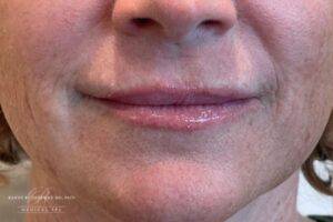 Face before dermal filler treatment, front view — Dr. Rudderman, Atlanta.