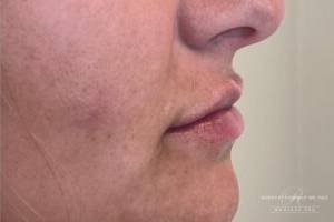 Dermal filler treatment patient photo, side profile view of the face — Dr. Rudderman, Atlanta.