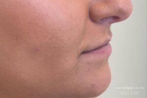 Dermal filler treatment patient photo, side profile view of the face — Dr. Rudderman, Atlanta.