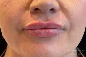 Face after dermal filler treatment, front view — Dr. Rudderman, Atlanta.