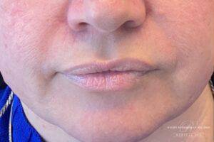 Face before dermal filler treatment, front view — Dr. Rudderman, Atlanta.