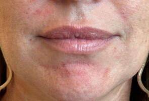 Dermal filler treatment patient photo, front view of the face — Dr. Rudderman, Atlanta.