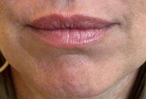 Face after dermal filler treatment, front view — Dr. Rudderman, Atlanta.