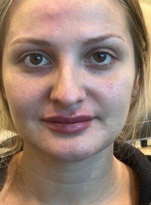 Dermal filler treatment patient photo, front view of the face — Dr. Rudderman, Atlanta.