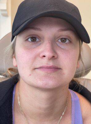 Dermal filler treatment patient photo, front view of the face — Dr. Rudderman, Atlanta.