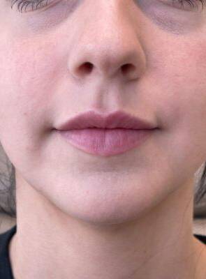 Face after dermal filler treatment, front view — Dr. Rudderman, Atlanta.