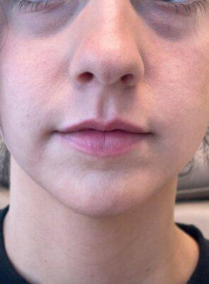 Face before dermal filler treatment, front view — Dr. Rudderman, Atlanta.