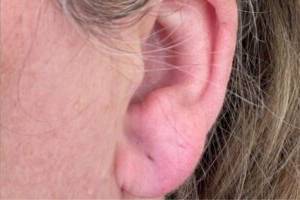 Dermal filler treatment patient photo, side profile view of the face — Dr. Rudderman, Atlanta.