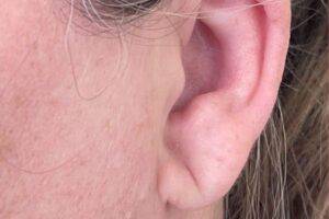 Dermal filler treatment patient photo, side profile view of the face — Dr. Rudderman, Atlanta.