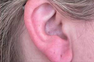 Dermal filler treatment patient photo, side profile view of the face — Dr. Rudderman, Atlanta.