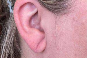 Dermal filler treatment patient photo, side profile view of the face — Dr. Rudderman, Atlanta.