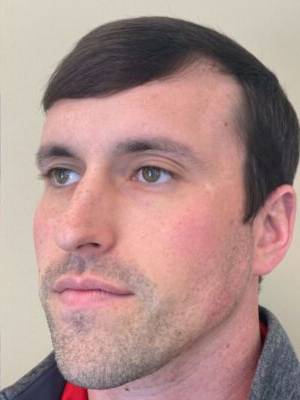 Dermal filler treatment patient photo, three-quarter view of the face — Dr. Rudderman, Atlanta.