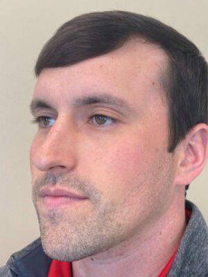 Dermal filler treatment patient photo, three-quarter view of the face — Dr. Rudderman, Atlanta.