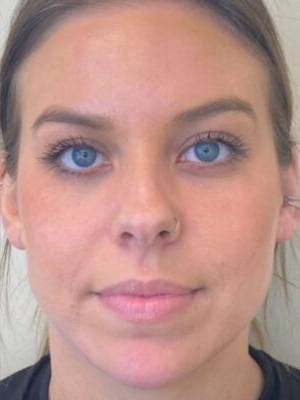 Dermal filler treatment patient photo, front view of the face — Dr. Rudderman, Atlanta.