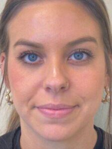 Dermal filler treatment patient photo, front view of the face — Dr. Rudderman, Atlanta.