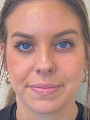 Dermal filler treatment patient photo, front view of the face — Dr. Rudderman, Atlanta.