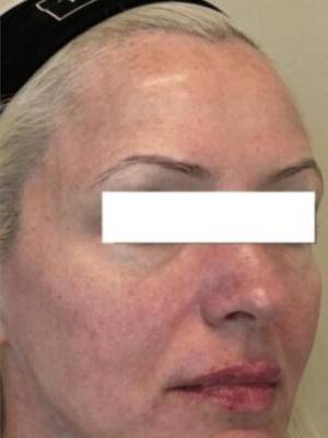 Dermal filler treatment patient photo, three-quarter view of the face — Dr. Rudderman, Atlanta.
