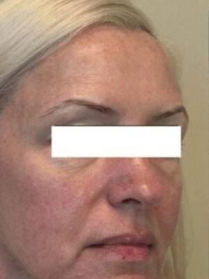 Dermal filler treatment patient photo, three-quarter view of the face — Dr. Rudderman, Atlanta.