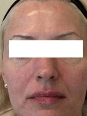 Dermal filler treatment patient photo, front view of the face — Dr. Rudderman, Atlanta.