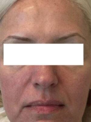Dermal filler treatment patient photo, three-quarter view of the face — Dr. Rudderman, Atlanta.