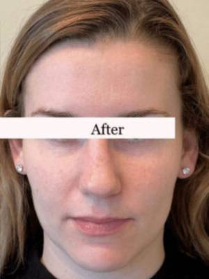 Face after dermal filler treatment, front view — Dr. Rudderman, Atlanta.