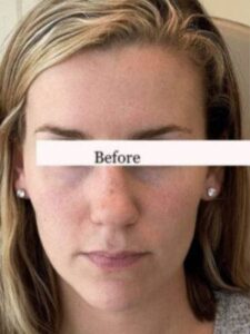 Face before dermal filler treatment, front view — Dr. Rudderman, Atlanta.