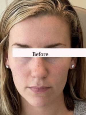 Face before dermal filler treatment, front view — Dr. Rudderman, Atlanta.