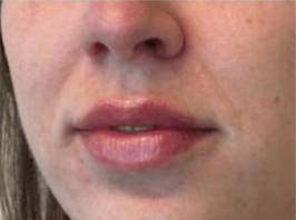 Face after dermal filler treatment, front view — Dr. Rudderman, Atlanta.