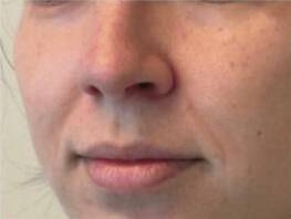 Face before dermal filler treatment, front view — Dr. Rudderman, Atlanta.