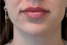 Face after dermal filler treatment, front view — Dr. Rudderman, Atlanta.
