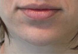 Face before dermal filler treatment, front view — Dr. Rudderman, Atlanta.