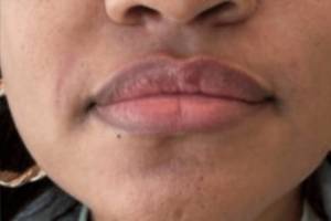 Dermal filler treatment patient photo, front view of the face — Dr. Rudderman, Atlanta.