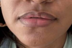 Dermal filler treatment patient photo, front view of the face — Dr. Rudderman, Atlanta.