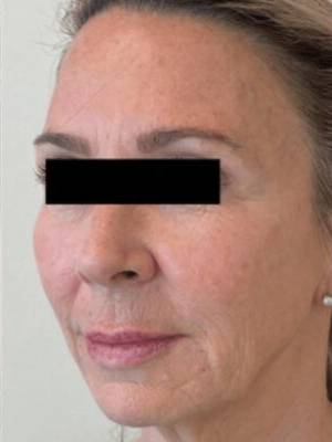 Dermal filler treatment patient photo, three-quarter view of the face — Dr. Rudderman, Atlanta.