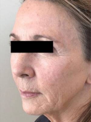Dermal filler treatment patient photo, three-quarter view of the face — Dr. Rudderman, Atlanta.