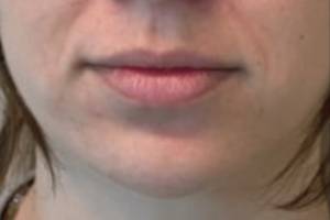Face before dermal filler treatment, front view — Dr. Rudderman, Atlanta.