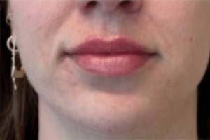 Face after dermal filler treatment, front view — Dr. Rudderman, Atlanta.