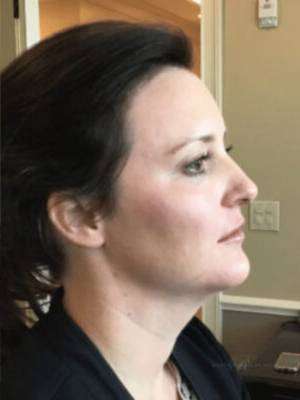 Dermal filler treatment patient photo, side profile view of the face — Dr. Rudderman, Atlanta.