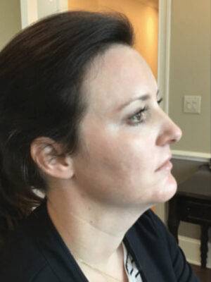 Dermal filler treatment patient photo, side profile view of the face — Dr. Rudderman, Atlanta.