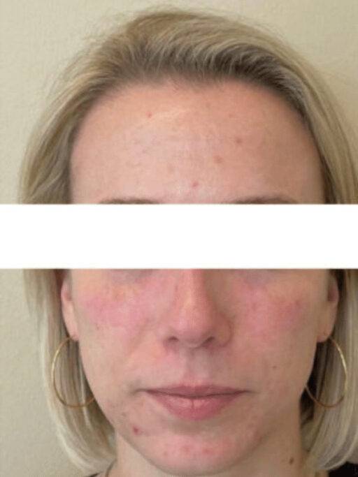 Dermal filler treatment patient photo, front view of the face — Dr. Rudderman, Atlanta.