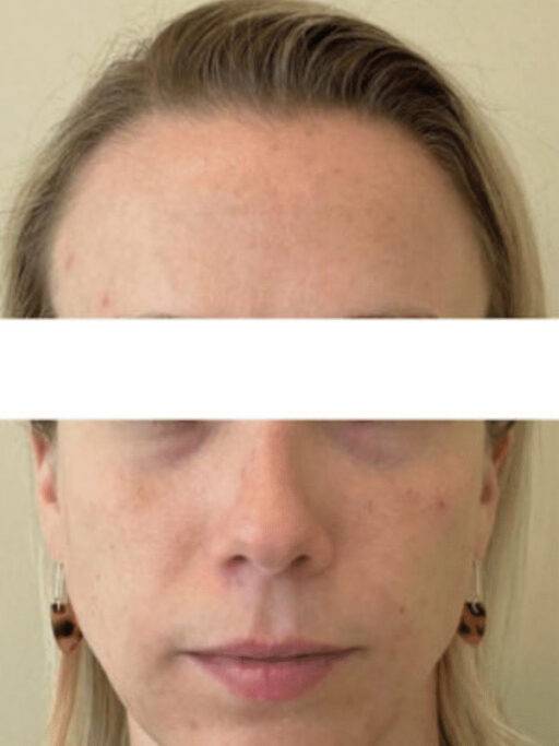 Dermal filler treatment patient photo, front view of the face — Dr. Rudderman, Atlanta.