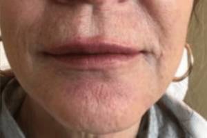 Face after dermal filler treatment, front view — Dr. Rudderman, Atlanta.