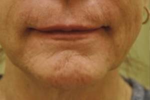 Face before dermal filler treatment, front view — Dr. Rudderman, Atlanta.