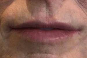 Face after dermal filler treatment, front view — Dr. Rudderman, Atlanta.