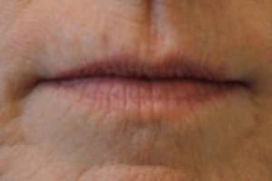 Face before dermal filler treatment, front view — Dr. Rudderman, Atlanta.